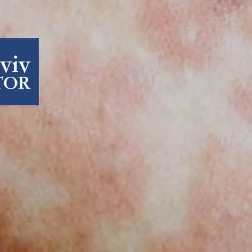 Measles Outbreak in Israel: Medical Facts