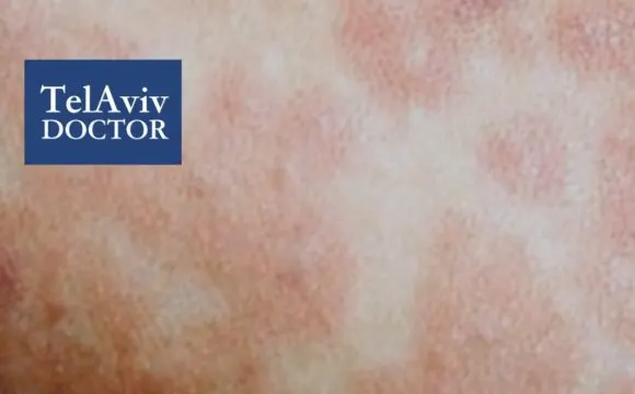 Measles Outbreak In Israel Health Advice | Tel Aviv Doctor