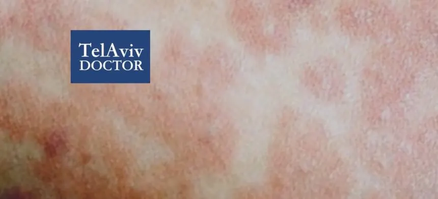 Measles Israel Outbreak | Tel Aviv Doctor Measles Outbreak In Israel Health Advice | Tel Aviv Doctor