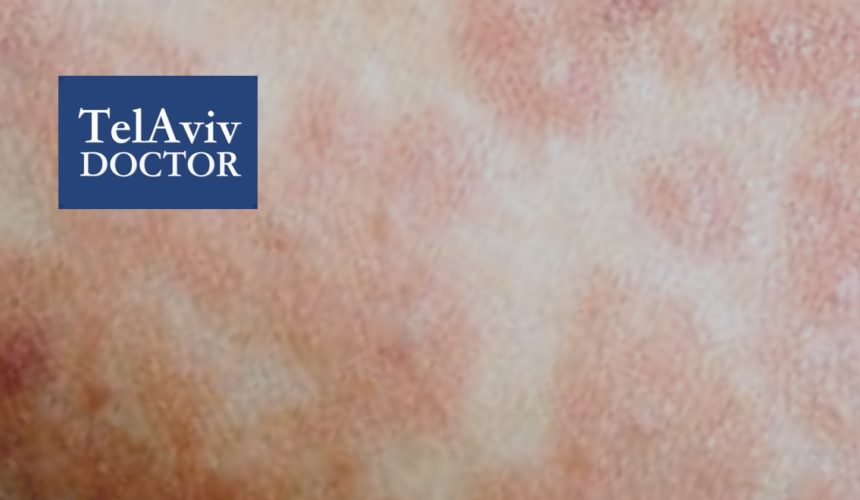 Measles Outbreak In Israel Health Advice | Tel Aviv Doctor - Part 2